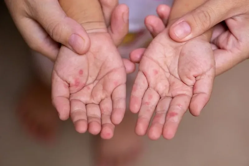Bệnh tay chân miệng có tốc độ lây lan nhanh chóng ở lứa tuổi mầm non và trẻ dưới 5 tuổi.