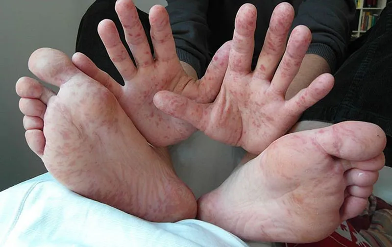 Phát ban dạng mụn nước ở lòng bàn tay và bàn chân là dấu hiệu đặc trưng của bệnh tay chân miệng.